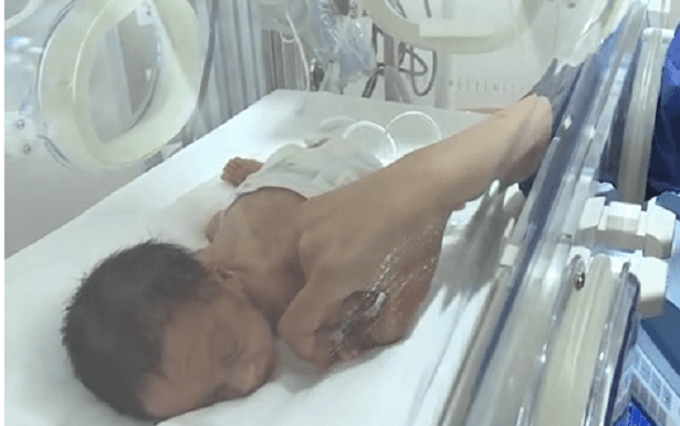 Ağırlığının iki katı tümörle doğan bebek sağlığına kavuştu 