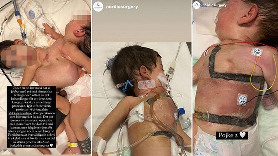 Aynı bedende nefes alan siyam ikizleri 9 saatlik ameliyatla ayrıldı