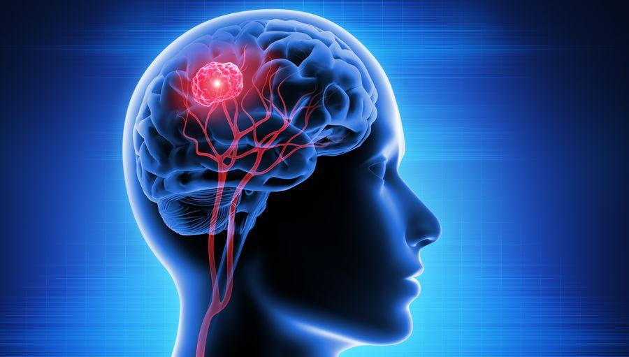 Bilim insanları yaygın görülen bir beyin tümörünün 3 alt türünü tespit etti