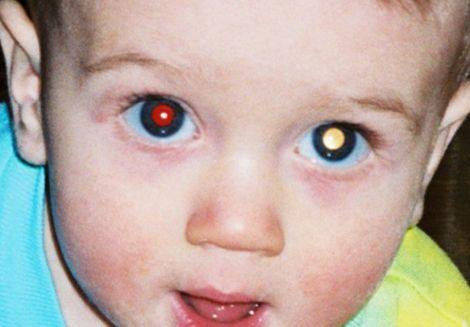 Fotoğrafta beyaz çıkan göz bebeği kanser habercisi olabilir