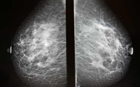 Tüm radyologlar mamoğrafi için özel eğitim alacak