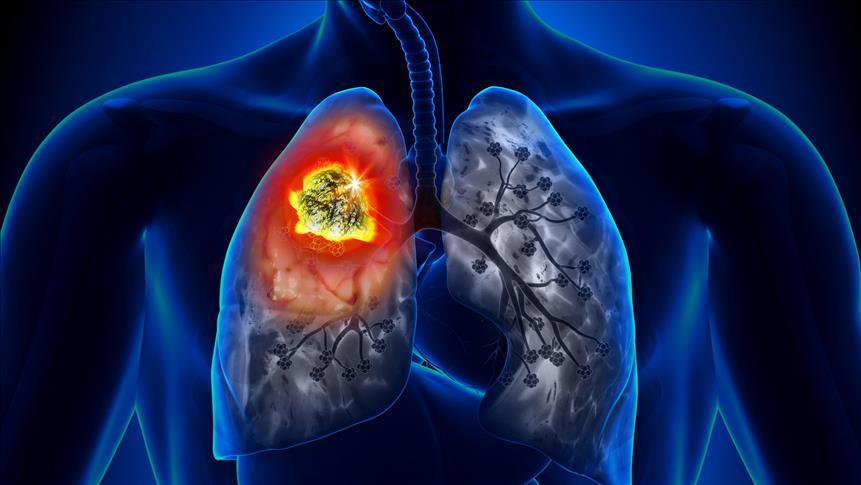 'Benzersiz' moleküler tedavi hamlesi, akciğer kanserini durdurmaya yardımcı olabilir
