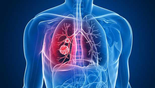 Sigaraya bağlı akciğer kanserinde immüno onkolojik tedavi