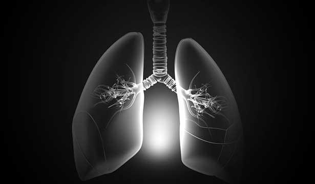 Yaygın akciğer kanserinde 'SBRT' yaşam süresini artırdı