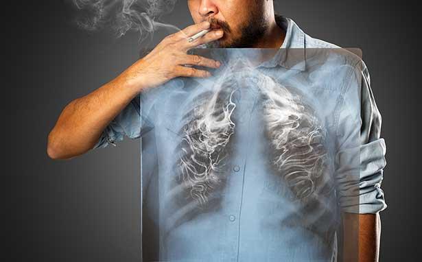 Araştırma: Tanı konulan hastaların yüzde 50'si sigara kullanımına devam ediyor
