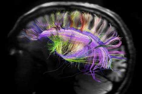 Aşık olan ve olmayan kişinin beyninin MR görüntüsü