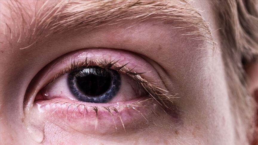 Gözün doğal görünümünü bozan hastalık: Pterjium