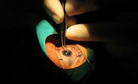 Katarakt ameliyatında yeni yöntem: Lens, şırıngaya girdi
