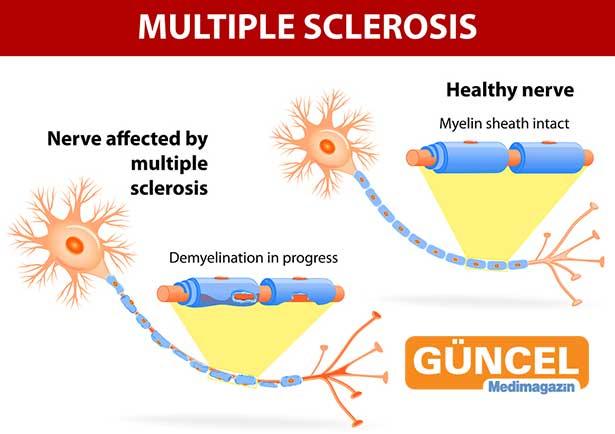 Multipl Skleroz (MS) belirtileri