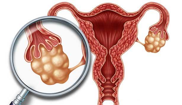 Endometriozis hakkında doğru bilinen yanlışlar!